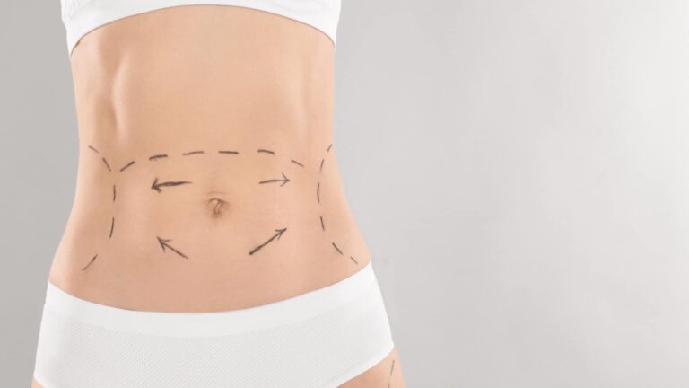 Abdominoplasty