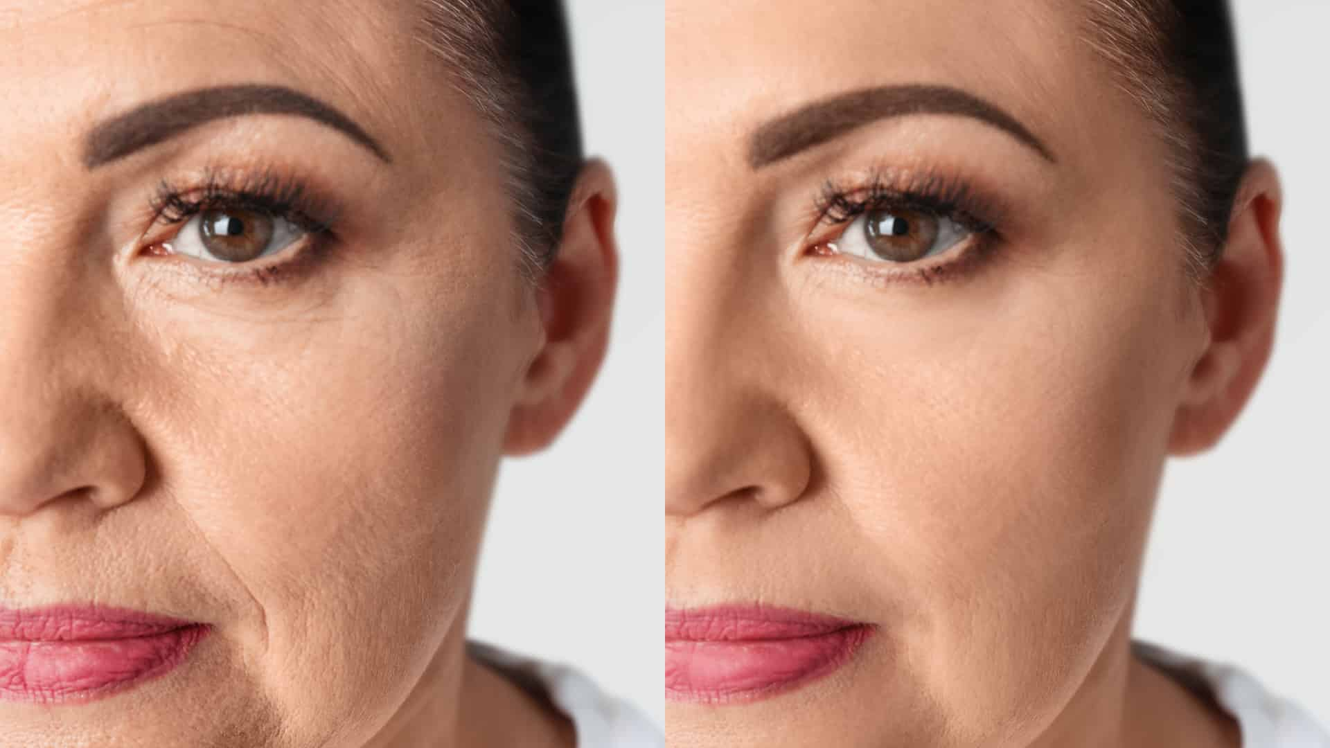 Non-Surgical Face Lift